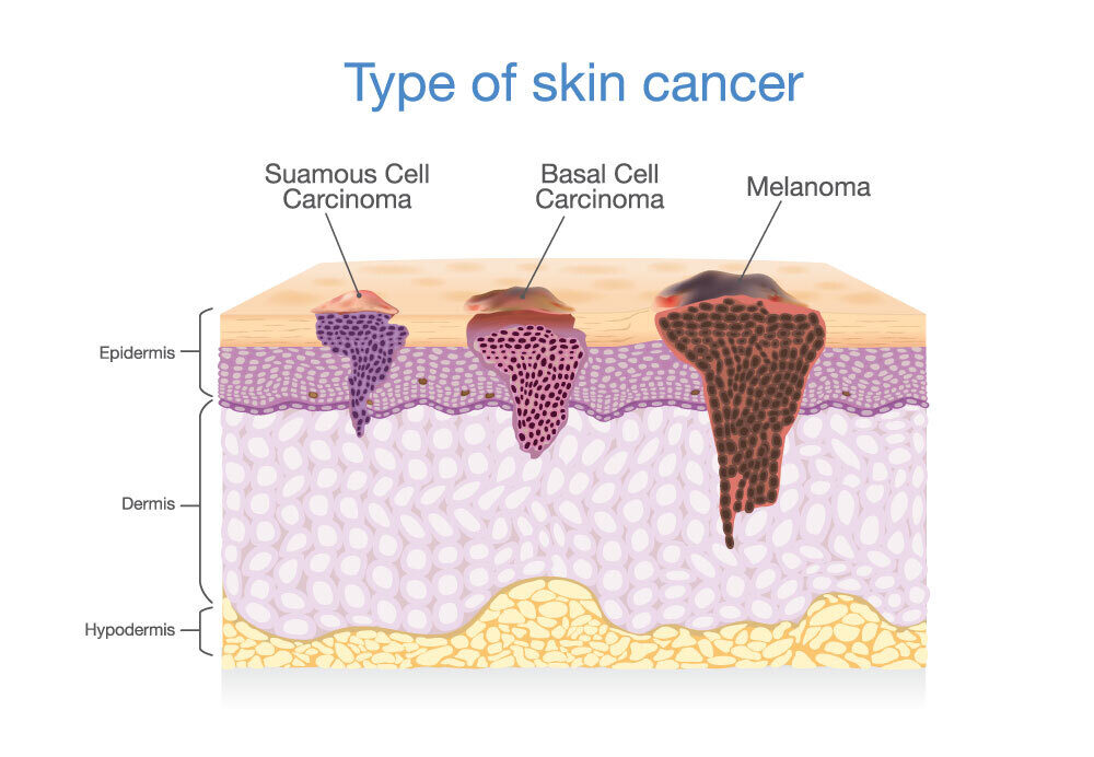 types of skin cancer