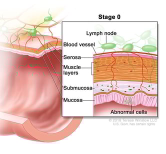 colon and rectal cancer stage 0 medical illustration
