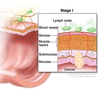 colon and rectal cancer stage 1 medical illustration