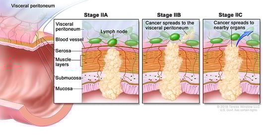 colorectal-cancer-stage-2