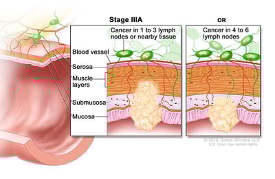 colorectal-cancer-stage-3A