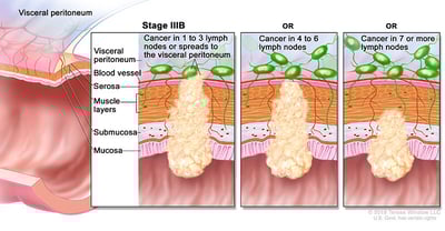 colorectal-cancer-stage-3B