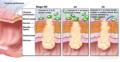 colorectal-cancer-stage-3C