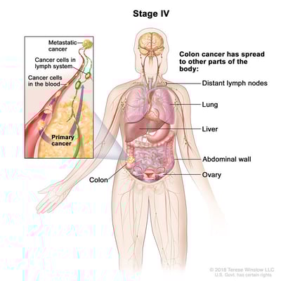 colorectal-cancer-stage-4