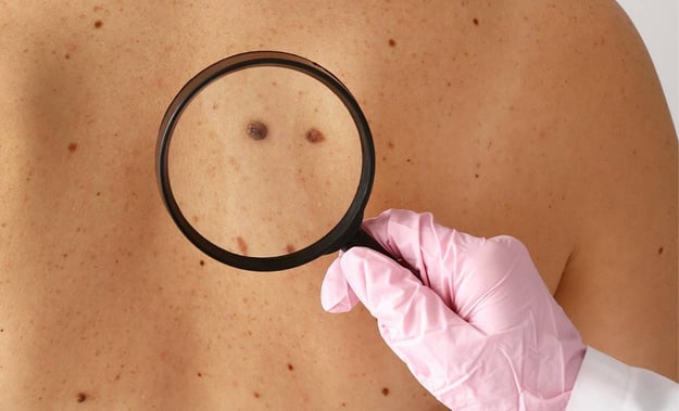 Detecting and Diagnosing Melanoma skin cancer - wvci