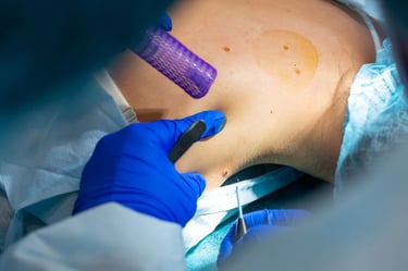 Melanoma Treatment Options - surgery- wvci