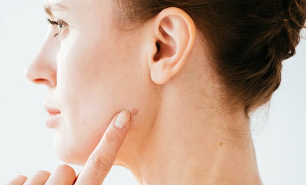Signs and symptoms of Melanoma  skin cancer - wvci