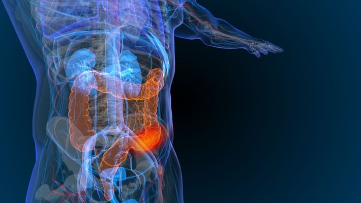 WVCI - t Treating Colorectal Cancer and Other GI Cancers