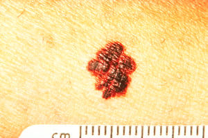 Melanoma skin cancer border image