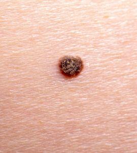 atypical-moles-dysplastic-nevi-image