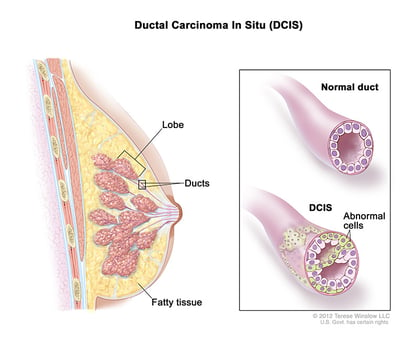 Ductal carcinoma in situ (DCIS) Breast Cancer