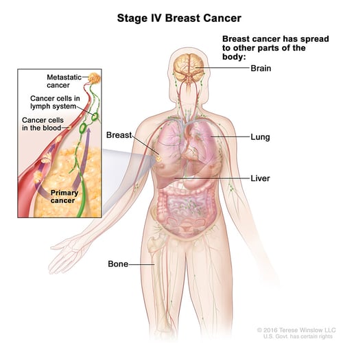 breast-cancer-in-stage-4