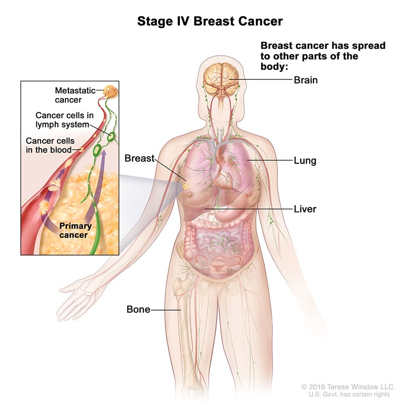 Stage 4 Breast Cancer