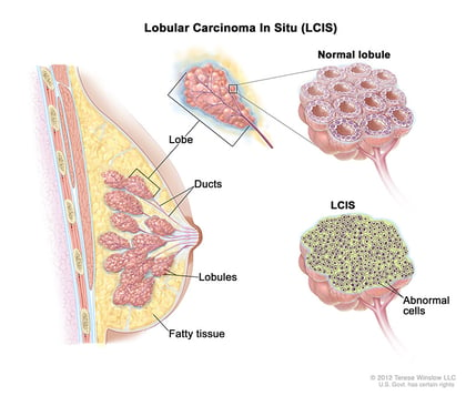 Lobular carcinoma in situ (LCIS) breast cancer