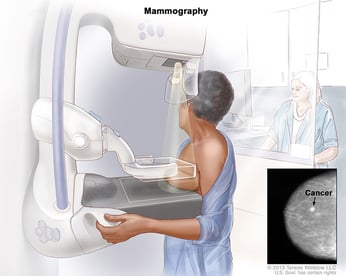 mammogram to detect breast cancer