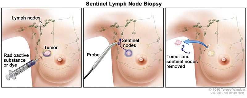 breast-sentinel-node-abc-title-1