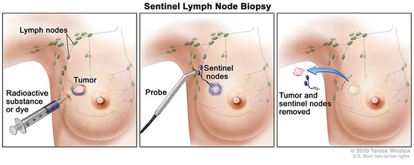 medical illustration of a sentinel lymph node biopsy in breast