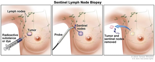 Sentinel lymph node biopsy for breast cancer