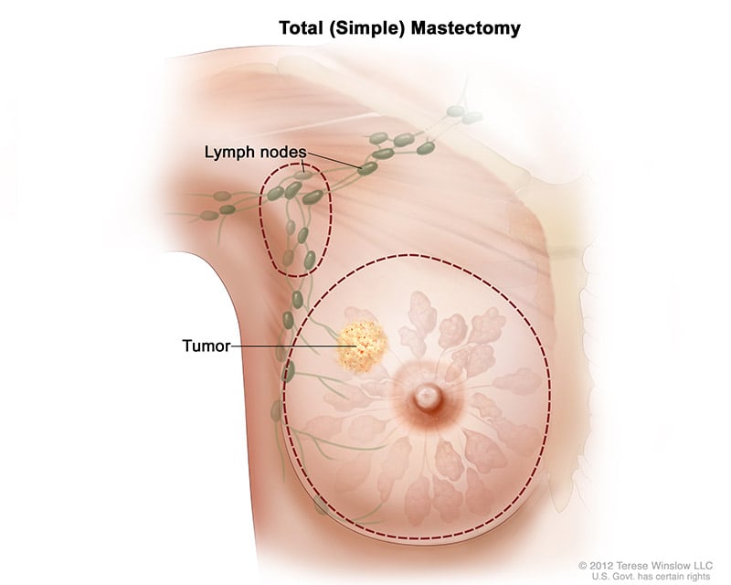 breast-total-simple-mastectomy
