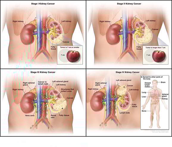 kidney-cancer-stages-all