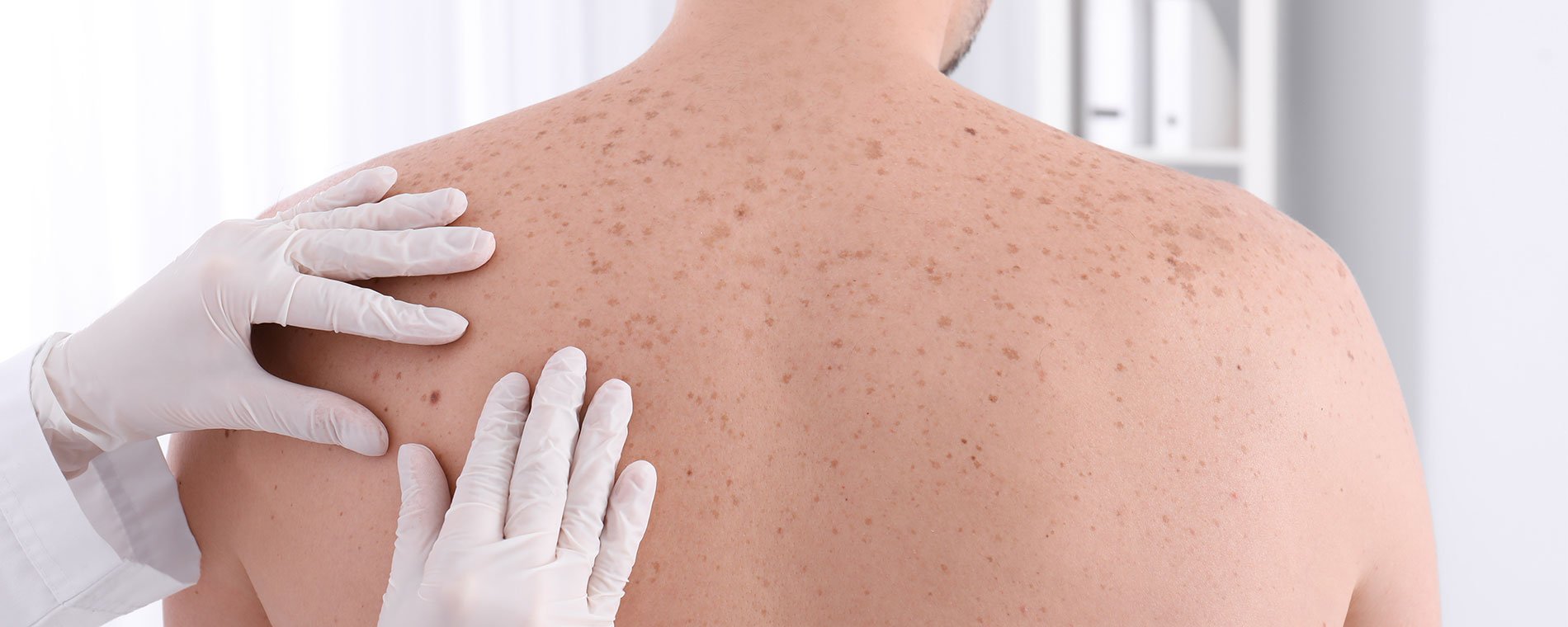 non-melanoma-skin-cancer-1