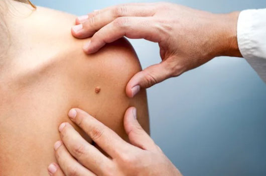 non-melanoma-skin-cancer-detection