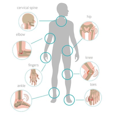 osteoarthritis