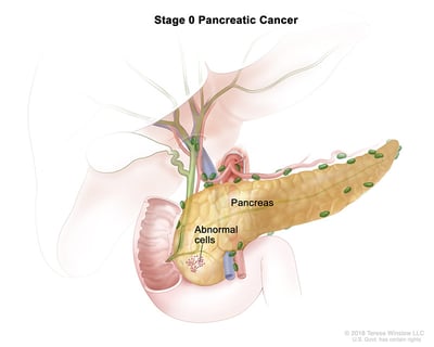 pancreatic-ca-stage-0