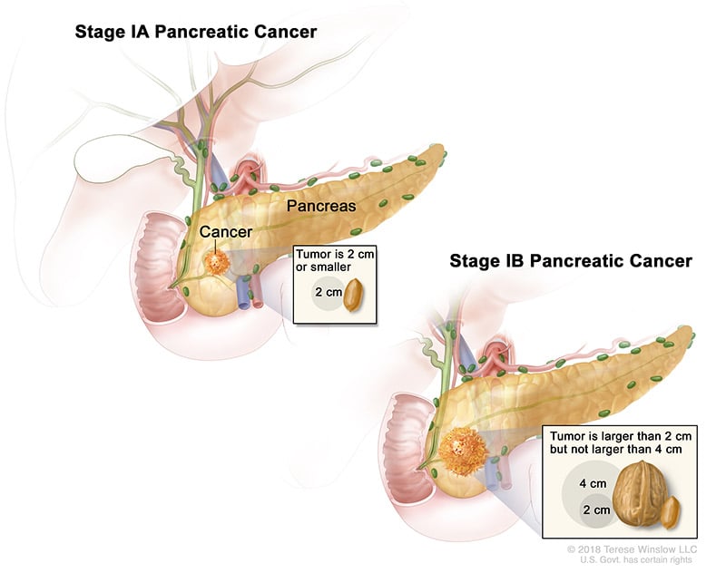 pancreatic-ca-stage-1A1B
