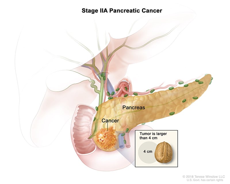 pancreatic-ca-stage-2A