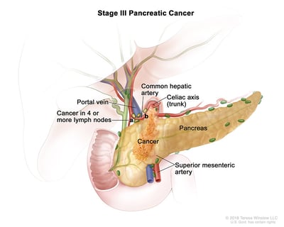 pancreas cancer