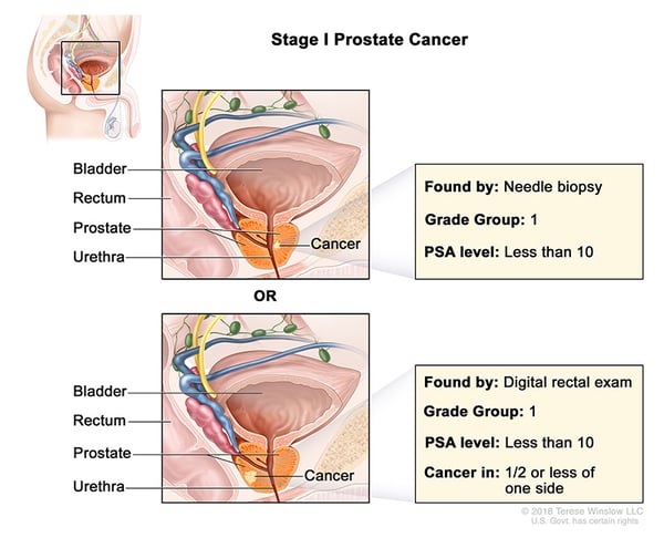 prostate-cancer-stage-1-WVCI
