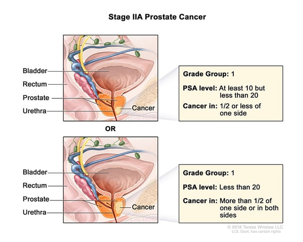prostate-cancer-stage-2A-WVCI