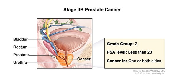 prostate-cancer-stage-2B-WVCI
