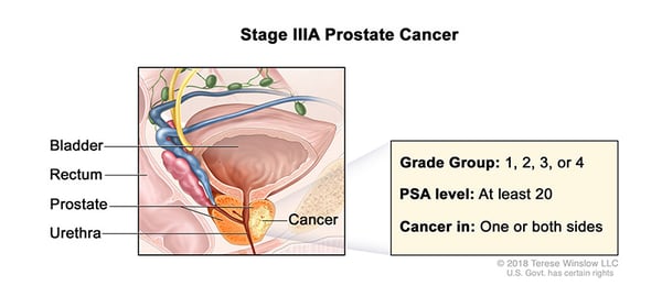 prostate-cancer-stage-3A-WVCI