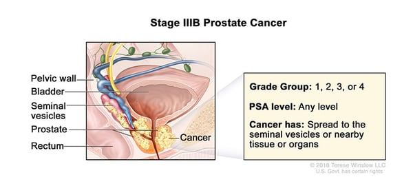 prostate-cancer-stage-3B-WVCI