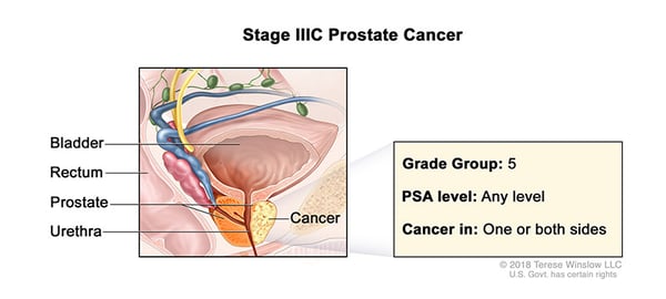 prostate-cancer-stage-3C-WVCI