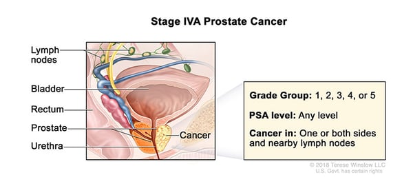 prostate-cancer-stage-4A-WVCI