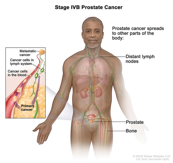 prostate-cancer-stage-4B-WVCI
