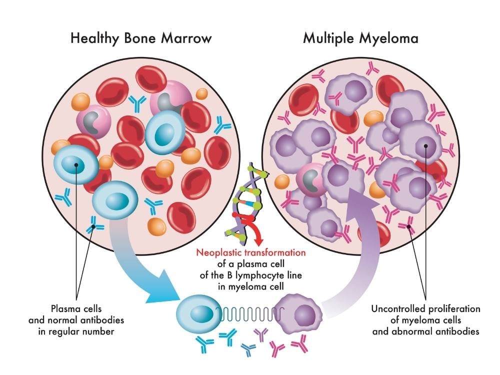 what is multiple myeloma diagram - wvci