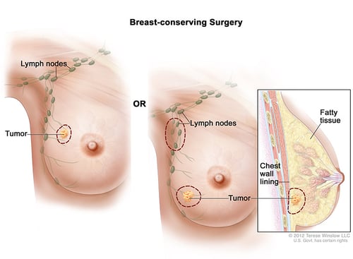 wvci-breast-conserving-surgery-female