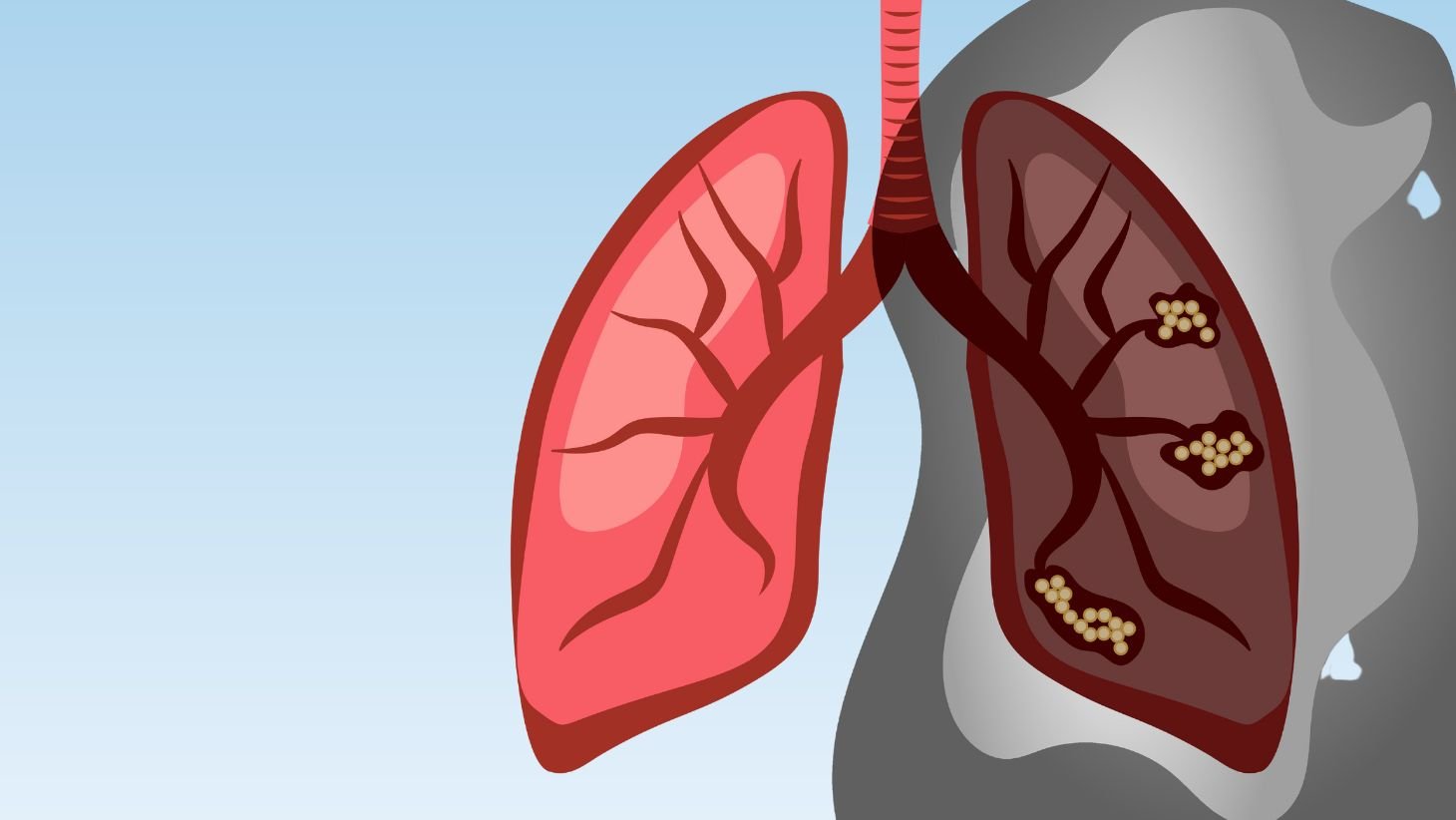 Top 5 Lung Cancer Causes in Non-Smokers