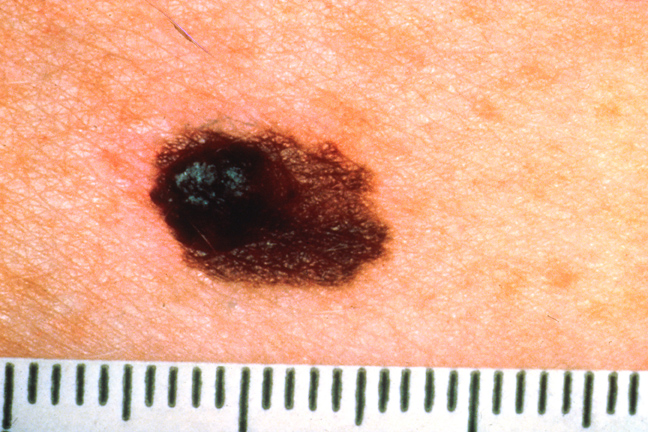 A for Asymmetry Skin Cancer